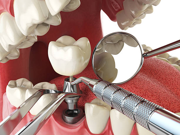 Best Emergency Root Canal Therapy in Calhoun, GA